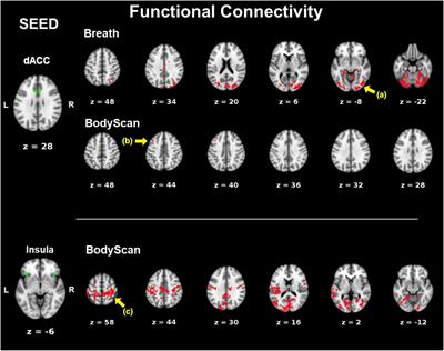 Interoceptive awareness: MBSR training alters information processing of salience network